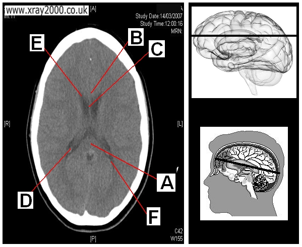 AXIAL SECTION 4.JPG